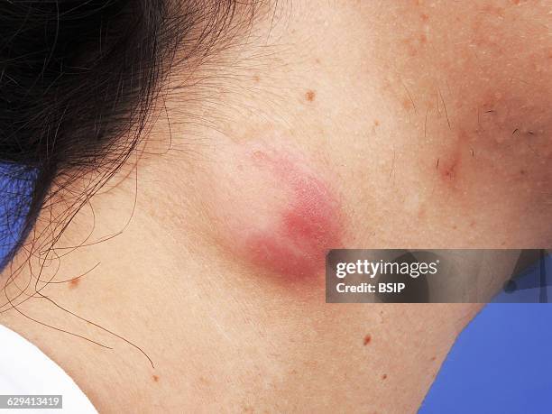 Sebaceous cyst on the neck.