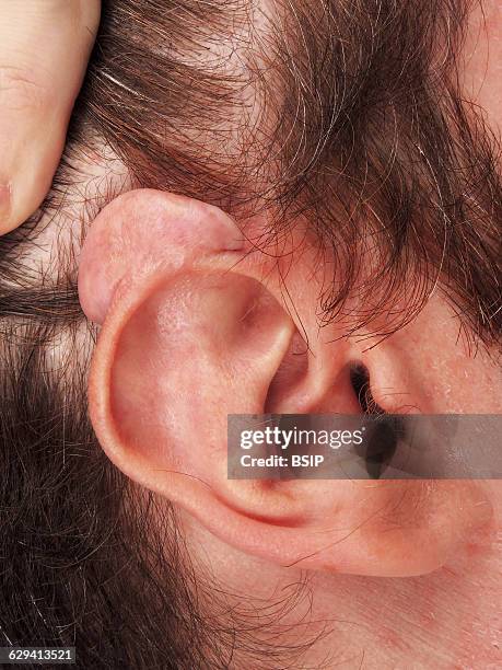 Ear Scar 122 Keloid Scar Stock Photos, High-Res Pictures, and Images - Getty Images