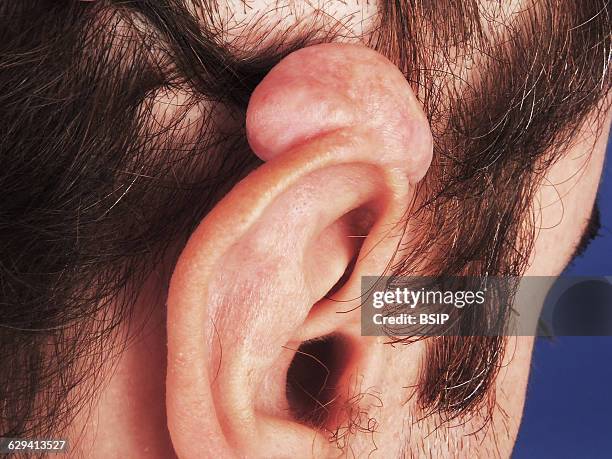 Keloid on the ear.