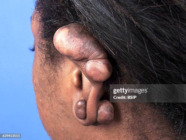 Keloid on the ear.