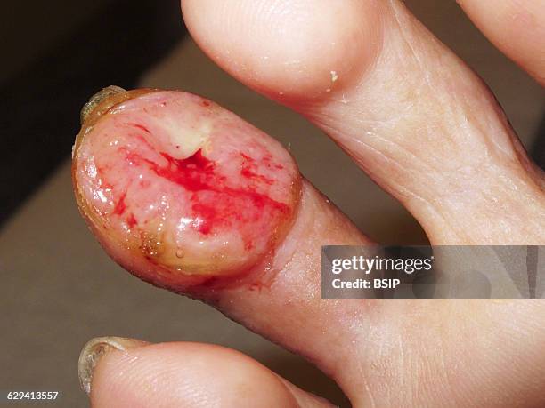 Infiltrating squamous cell carcinoma.