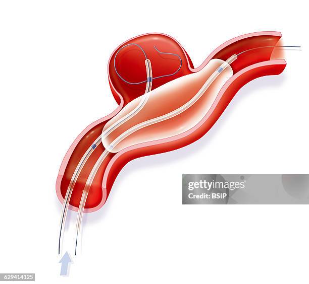 Illustration of the second stage of treatment for a large aneurysm. The coils are inserted into the aneurysm to cause blood clotting. The balloon is...