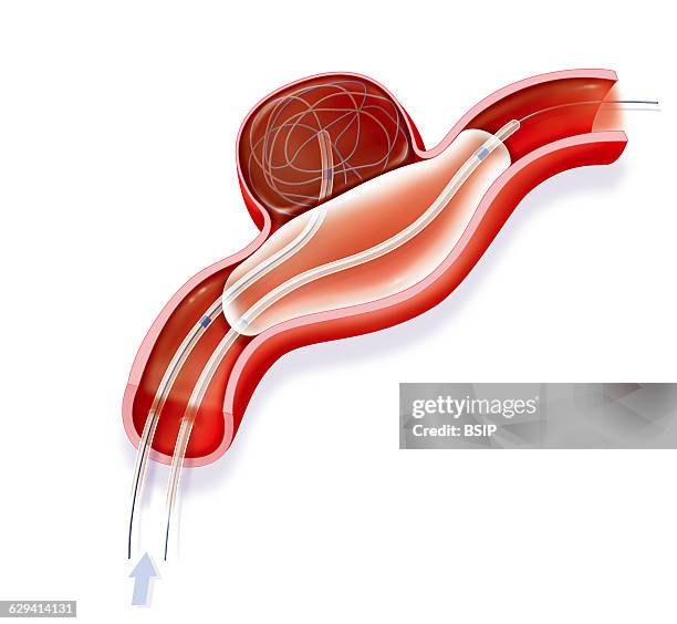 Illustration of the third stage of treatment for a large aneurysm. The coils have caused blood in the aneurysm to clot and not in the artery, blocked...