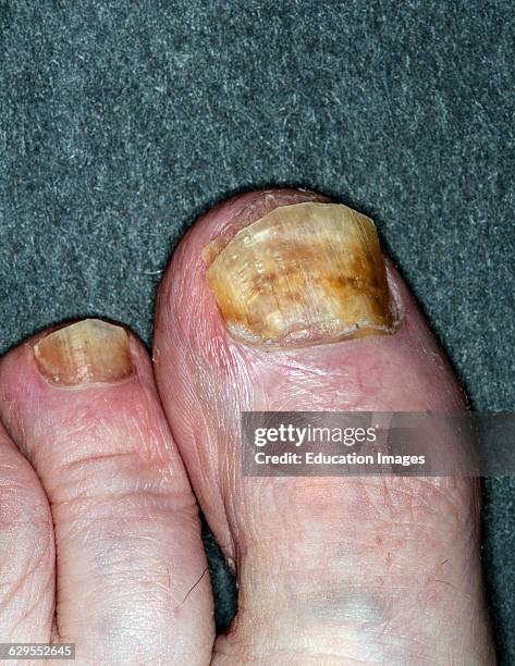 Vadnais Heights, Minnesota. Toe nail fungus. An infection of nail fungus occurs when fungi infect one or more of your nails.