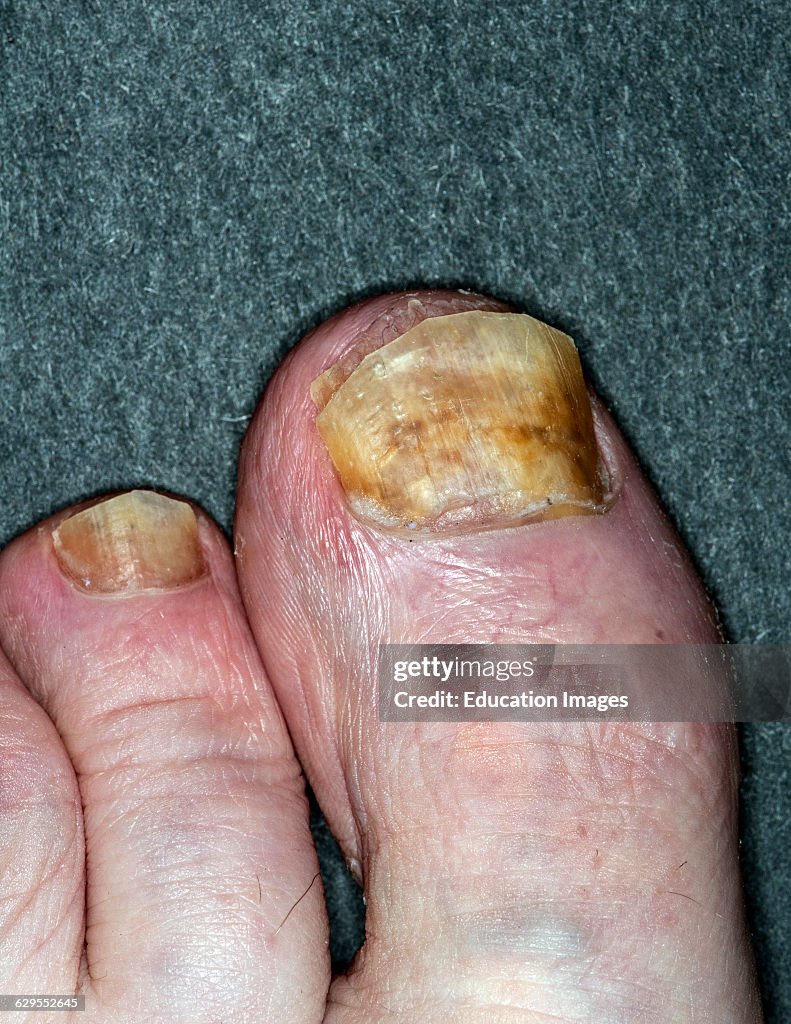 Toe nail fungus