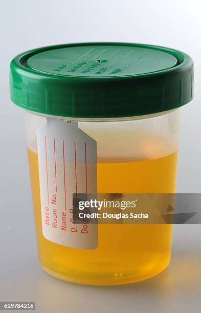human urine sample in a sealed container - a container for urine stock-fotos und bilder