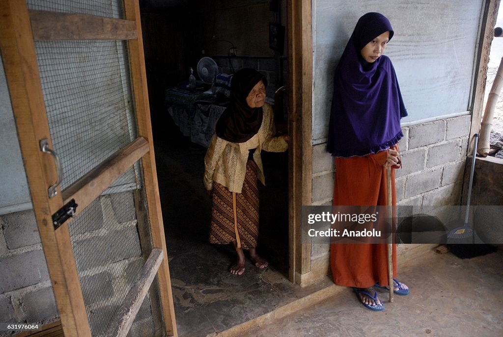 Indonesian woman suffers from rare disease