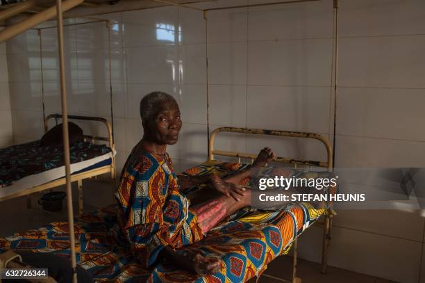 An elderly woman that suffered from Buruli ulcers shows the scars of a skin graft operation she received at the Follereau Foundation for leprosy...