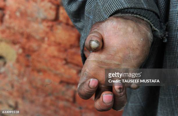 Leprosy patient holds out his hand at the leprosy hospital in downtown Srinagar on January 30, 2017. World Leprosy Day is observed on January 30 to...