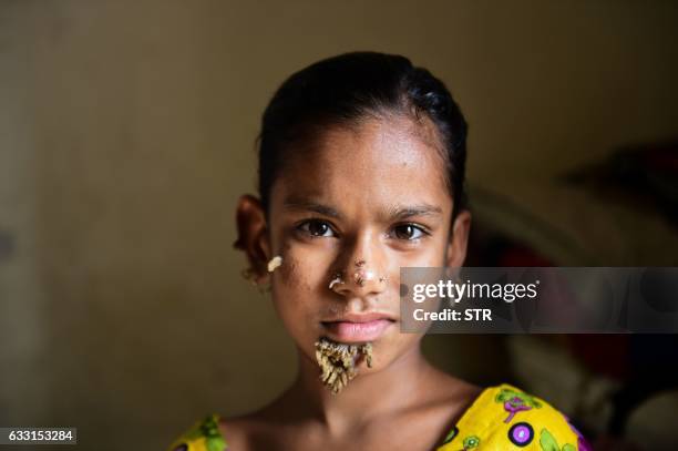 In this photograph taken on January 30 Bangladeshi patient Sahana Khatun poses for a photograph at the Dhaka Medical College and Hospital. A young...