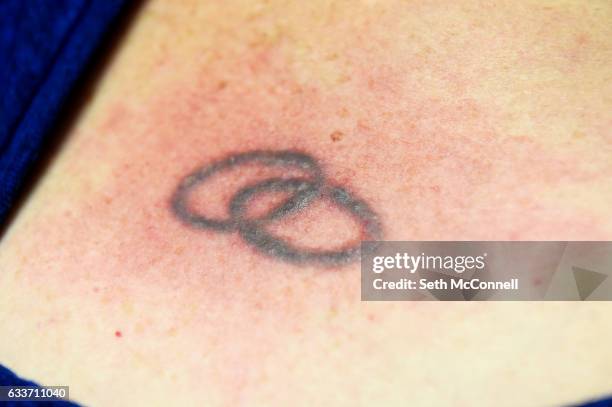 The tattoo on Cathy Manasil's chest is inflamed and puffy following a tattoo removal session at Fresh Start Body Aesthetics and Laser Tattoo Removal...