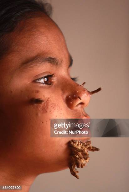 Girl afflicted with bark-like warts on her face has been admitted to Dhaka Medical College Hospital, where two others with similar condition are...