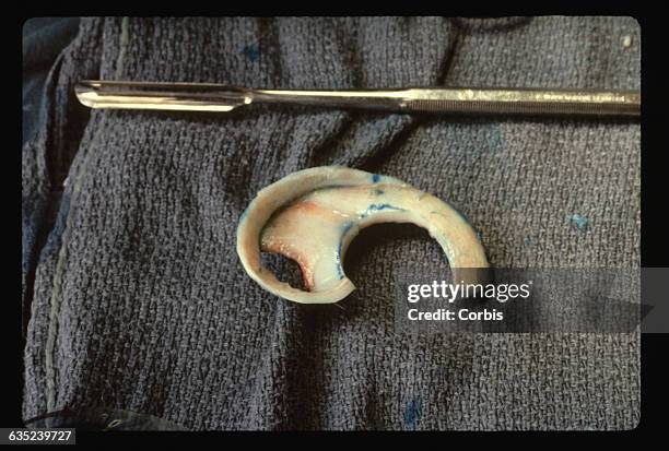 Reconstructed Ear From Rib 1,791 Rib Cartilage Stock Photos, High-Res Pictures, and Images - Getty ...