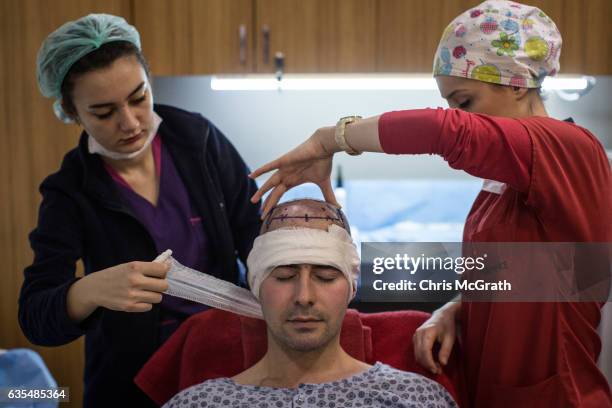 Patient undergoes a hair transplant procedure at the luxury Esteworld Clinic on February 15, 2017 in Istanbul, Turkey. Esteworld clinic is one of...