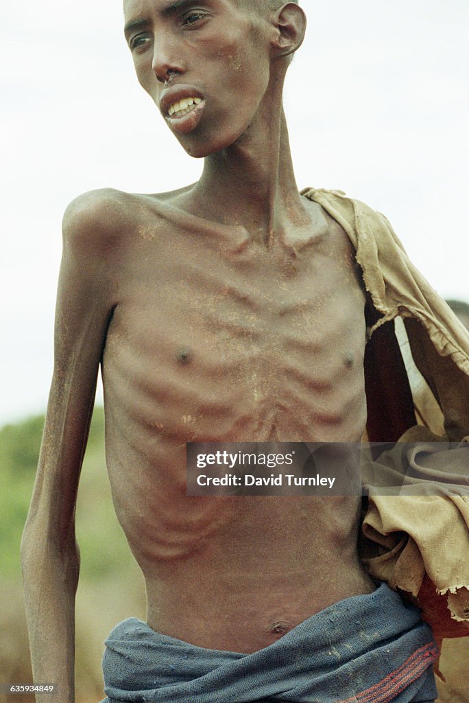 A Somalian man surviving as a skeleton in a famine sticken village