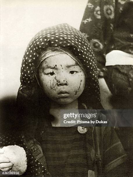Victim in Nagasaki after Atomic Bomb strike in 1945.