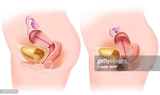 Illustration of a uterine prolapse, the uterus descends into the vaginal cavity.