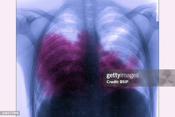 Acute bilateral pneumonia , seen on a frontal chest x-ray.