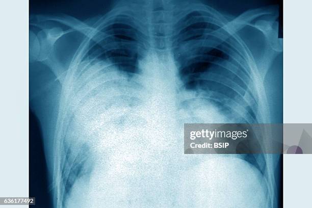 Acute bilateral pneumonia , seen on a frontal chest x-ray.