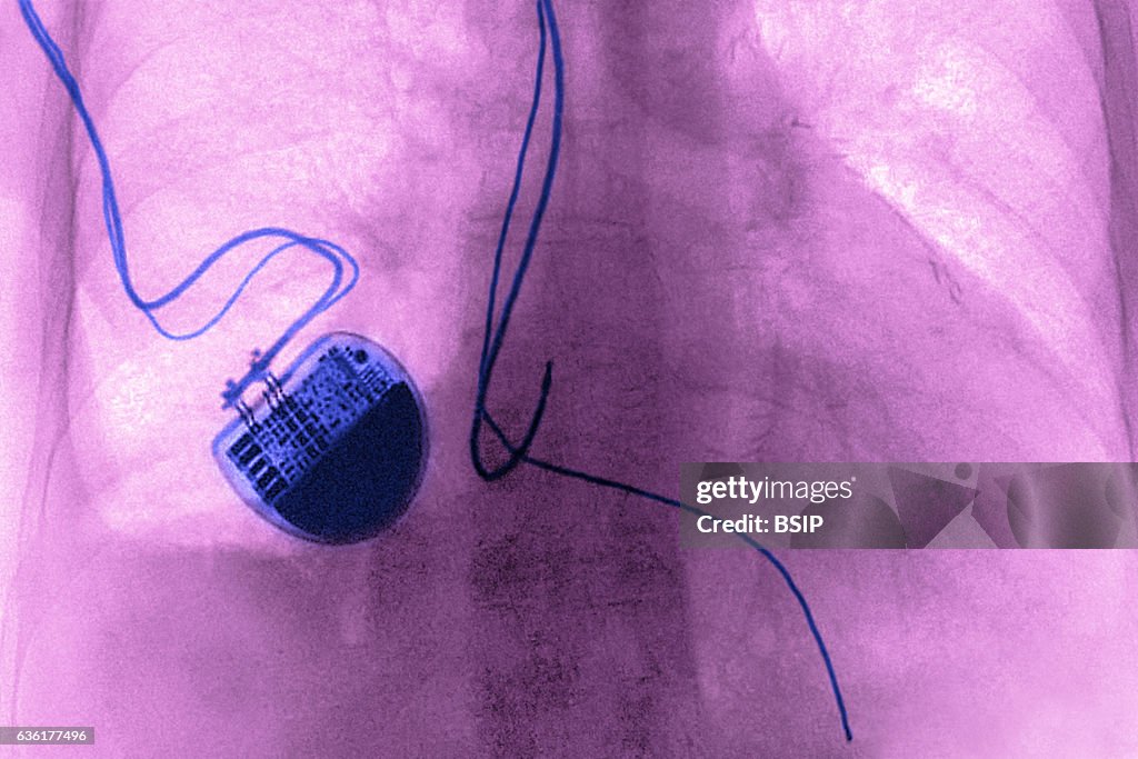 Foto Pacemaker Implanted Pacemaker seen on a frontal chest x-ray. Nachrichtenfoto ...