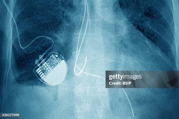 Foto Pacemaker 254 Pacemaker Ecg Stock Photos, High-Res Pictures, and Images - Getty ...