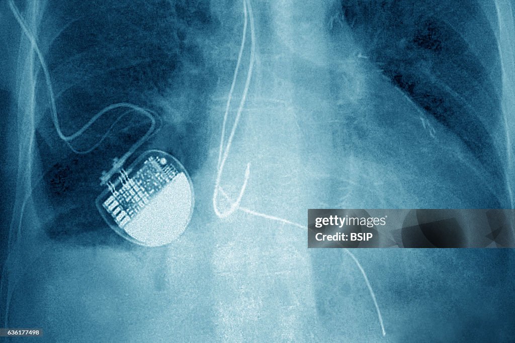 Pacemaker Radiology Implanted Pacemaker seen on a frontal chest x-ray. News Photo - Getty ...