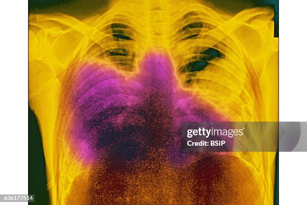 Acute bilateral pneumonia , seen on a frontal chest x-ray.