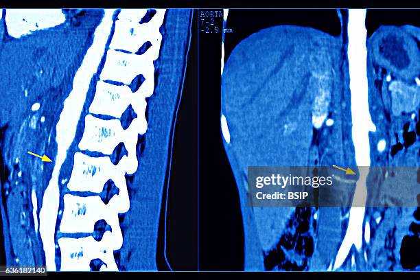 Takayasu's arthritis, seen by 2 adominal scanners , at the descending aorta.
