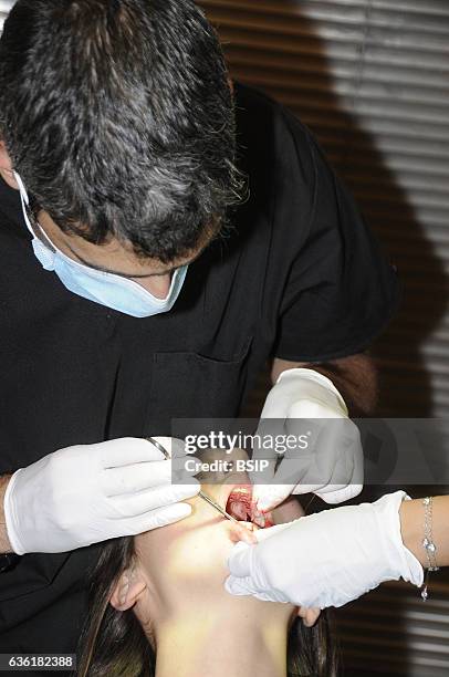 Gingival graft. Placing and fine stitching the graft. For the gingival graft to take, the graft must be perfectly immobilised.