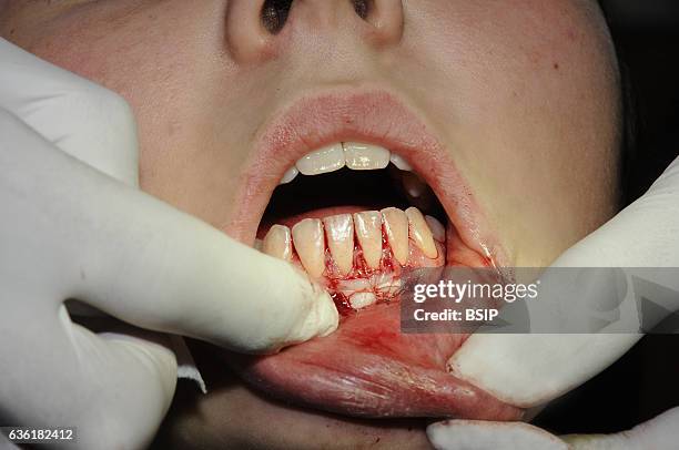 Gingival graft. The stitched graft. A dressing covers the graft and holds it in place. It is like chewing gum.