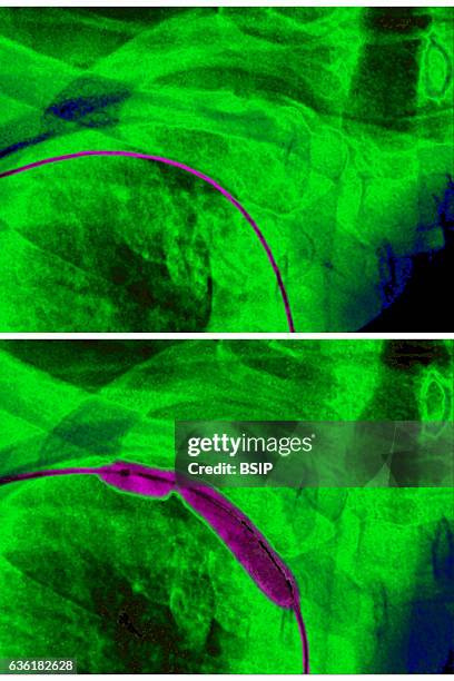 Transluminal agioplasty of the right, subclavian artery, seen on a frontal chest x-ray.