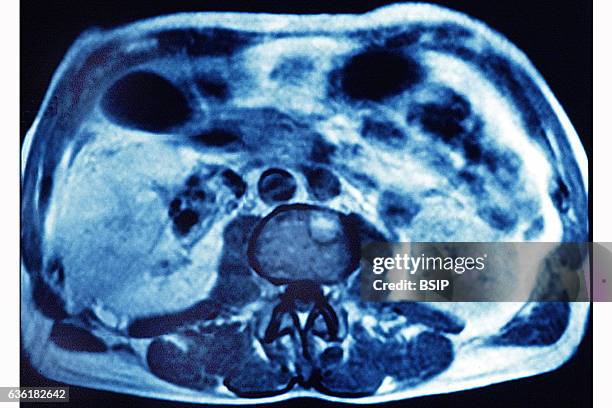 Cancer of the liver, seen in a radial cross-section abdominal scan.