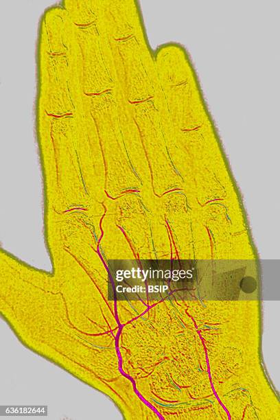 Arteritis seen in an angiogram of the left hand.