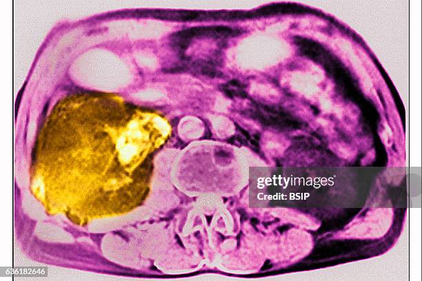 Cancer of the liver, seen in a radial cross-section abdominal scan.