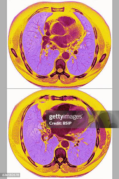 Heart and lungs seen in a radial cross-section MRI scan.