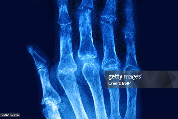 Rheumatoid arthritis seen on an x-ray of the hand.