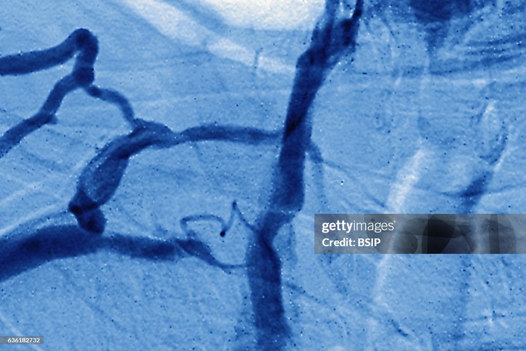 Venous stenosis, angiography