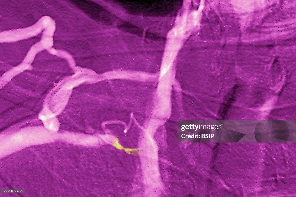 Venous stenosis, angiography