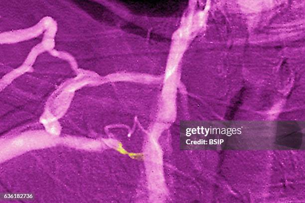 Venous stenosis of the superior vena cava seen in a frontal chest angiogram.