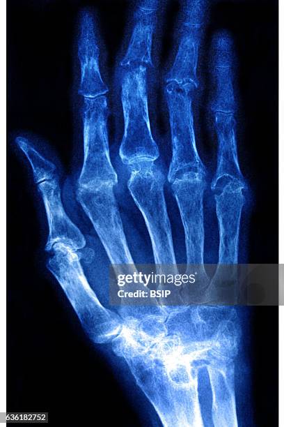 Rheumatoid arthritis seen on an x-ray of the hand.