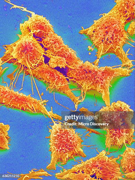 colon cancer cells - colorectal cancer stockfoto's en -beelden