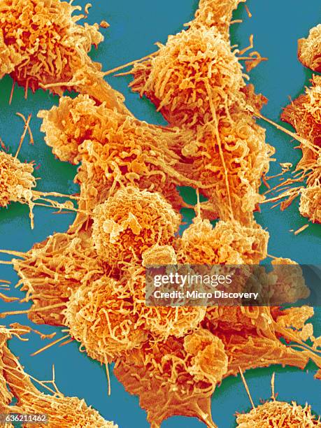 colon cancer cell - colorectal cancer stockfoto's en -beelden