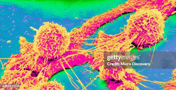 scanning electron micrograph of a colon cancer cell - colorectal cancer stockfoto's en -beelden