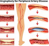 Diagram showing angioplasty for peripheral artery disease