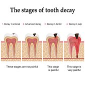 Tooth decay formation