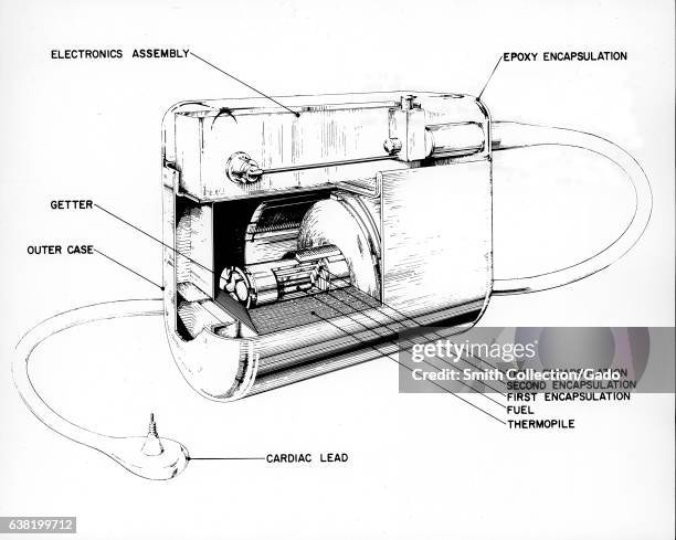 First Pacemaker Prototype Pacemaker Photos and Premium High Res Pictures - Getty Images