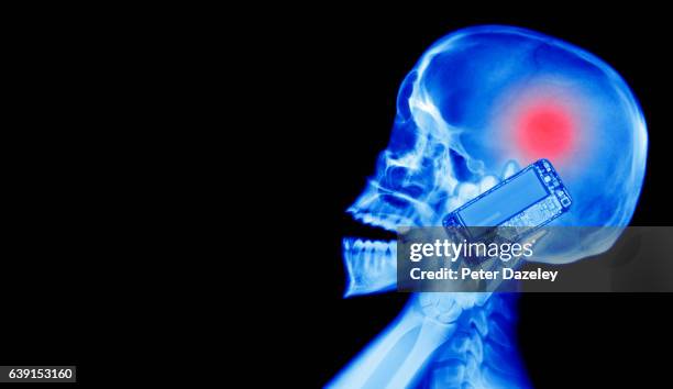 brain tumour x-ray - skull xray no brain stock pictures, royalty-free photos & images