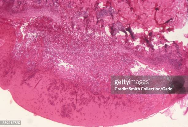 Micrograph showing the histologic changes in human skin infected with smallpox, prepared with hematoxylin-eosin stain, 1975. .