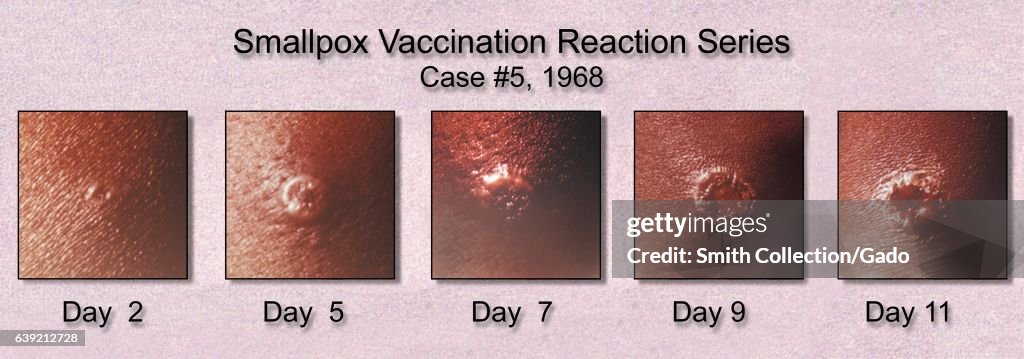 Progression of the appearance of a Smallpox vaccination site,... Photo ...