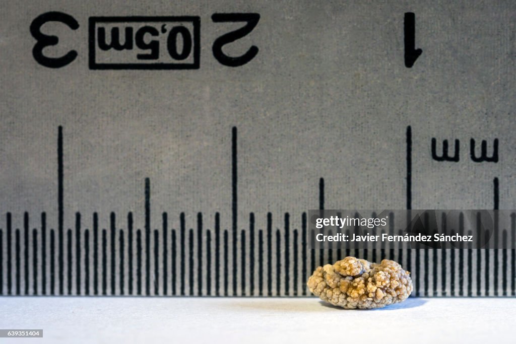 Kidney Stone Ruler Closeup Detail Of A Kidney Stone Due To Nephritic Colic With A Ruler ...